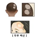 두부 백선(Tinea Capitis) 이미지