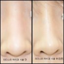 코필러전문 리더스미피부과 강남점 후기 보여드릴께요~♥