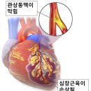 스텐트란 무엇인가 인터넷 복사본 이미지