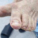 서원메디칼 | 파고드는발톱 메디컬풋케어 내성발톱 발각질 관리 솔직 후기