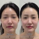 마이크로닉 | 화명동피부관리 톤에스테틱 알테온 풀페이스 코르셋관리 내돈내산 후기