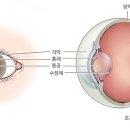 아이데코 안경콘택트 이미지