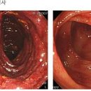 허혈성 대장염 원인 검사 및 이미지