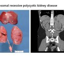 Autosomal recessive polycystic kidney disease 이미지