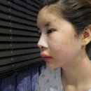 ●안면윤곽수술후기 : AJ성형외과(압구정앤) 리라의 성형후기!●
