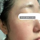 수로한의원 | 성인 여드름 한의원에서 고질적인 피부 문제까지 잡았다