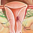 자궁암종류 & 자궁암 원인 [자궁암] 이미지