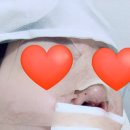 니코복코 | 복코재수술 당일후기 | 당일~3일차 (준비물&amp;주의사항)