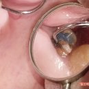 베스트 얼라인 치과기공소 | 크라운 빠졌다고 단순히 다시 붙이면 될까요?