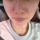 올포원 | 왕십리피부과 예식 전 올포원(Co2 + 토닝 + IPL + 그린레이저) 후기