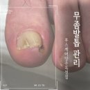 옥정제일약국 | 동두천무좀발톱 케어 약 열심히 발라도 안 낫는 이유