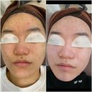 압출부터 림프마사지까지 꼼꼼하게 진행해주는 안성 여드름 관리 공도 퓨어에스테틱 다니는 중이에요