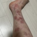 두피건선/물방울건선/판상형건선 실제 겪은 후기 총정리(자가면역질환 이겨낼 수 있어요)