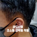 전주보청기 세계보청기 경도 난청 초소형 고막형(IIC) 착용 사례 이미지