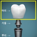웰치과기공소 | 성화동 치과, 임플란트? 이 2가지 놓치면 10년 못씁니다.