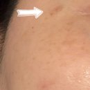 차서한의원 | 노원구한의원 눈흉터 치료 새살침 4회차 후기