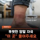 씨티티엘 | 고관절 순환 막혔다고 살이 이렇게 붓고 찐다고? 하체부종 신호 3가지