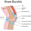 무릎(슬관절) 주위의 점액낭염 (Knee Bursitis) 이미지