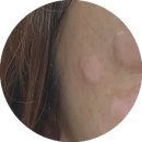 청담아이(i)성형외과의원 | 강남 청담역 리팟레이저 후기2- 잡티, 검버섯, 흑자, 표피성 색소 레이저(내돈내산)