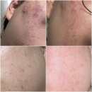 다드림 | 가산 여드름관리 가디역 문제성 피부관리 다드림 내돈내산 후기