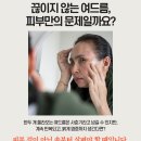 하늘토한의원 | 수원여드름 피부과, 반복 여드름 끝내는 방법