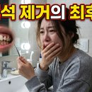 S.M의료기 | 시중에서 파는 셀프 치석 제거기가 소중한 치아를 영구적으로 망치는 이유