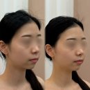 춘천-강남하이엔드 | 3D 브이팅으로 동그란 얼굴 대탈출 :: 춘천 윤곽관리 추천 [온리뷰티]