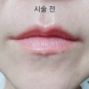 어린공주성형외과의원 | [공지] 어린공주성형외과 입술필러 후기 + 개인정보 실명 공개당한 이야기