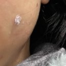 에스앤유서울병원 | 마포공덕 에스앤유피부과 화농성육아종(체리점/혈관종) 치료 두번째 기록