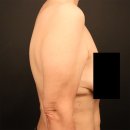 비에스티성형외과의원 | 팔거상 흉터 후기로 보는 - BST성형외과