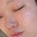 루아에스테틱광주점 | 유앤희에스테틱 광주첨단점 하이퍼젯 모공, 물광피부관리 후기