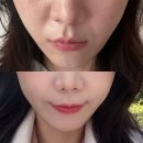포레스트성형외과 | 팔자주름 가장 효과 좋았던 포레스트 리프팅 후기(시술당일부터 일주일차까지)