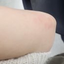 백상한의원 | 만성 두드러기 치료?라고 하기엔 애매하지만, 약 안 먹구 두달 버텼다😆