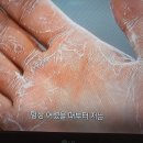 다한증,보톡스 치료,요추교감신경 절제술 이미지