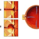 건강 상식**녹내장 이미지