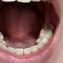 지아이치과기공소 | 어금니 플라즈마 신경치료 및 온레이 후기