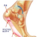 족저근막염&마라톤. 이미지