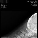 정강한의원 | 소뇌위축증 치료 사례: 2주간의 입원치료로 Tandem gait(일자보행) 3~4보 → 10보 가능해진 변화!