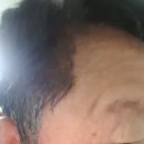 서원필피부과의원 | 손톱 무좀 완치해주는 서원필 피부과 치료후기