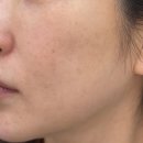 차한의원 | 강동구 듀얼토닝 1회차 둔촌동 한의원 만족후기