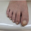 세종무좀발톱 박리발톱 해결 후기 발데렐라 // 내성발톱 무좀발톱 발각질