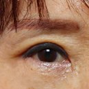 최문섭피부과의원 | 그레이스성형외과 꺼진 눈 지방이식 Q&amp;A