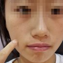 신사동-20 | 리쥬란 힐러 후기 운동 주의사항 신사동 피부과 20대 여자 내돈내산