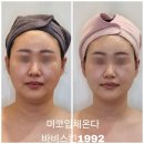 목동 에스테틱 바비스킨1992 미코온다 리프팅 후기