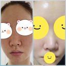 헤라에스테 | 주사염~ 완치는 가능한가? 헤라에스테틱의 후기 올바른 화장품 사용법(헤라에스테틱,염증성여드름,주사...