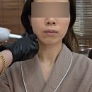 정릉58 | 성신여대 3cm리프팅 눈에 바로 보이는 효과 리얼 체험 후기 <엠케이에스테틱>