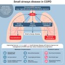 Re: 만성폐쇄성 폐질환(COPD) 원인, 유병률, 병기, 예후 등의 정리!! 이미지