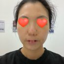 메이퓨어의원 | 피부과 후기_ 메이퓨어의원 수지점(내돈내산 무보정후기!) - 피코듀얼토닝+ldm