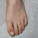 인천우리병원 | 청소년 인천내성발톱병원, 중학생 교정치료 후기