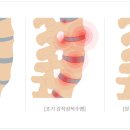 허리통증, 허리디스크 아닌 ‘강직성척추염’? 이미지